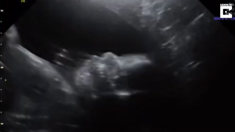 准妈妈查看超声波 宝宝伸手打招呼